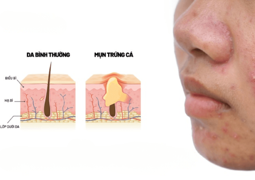 Mụn trứng cá là gì? Triệu chứng, nguyên nhân và cách điều trị hiệu quả