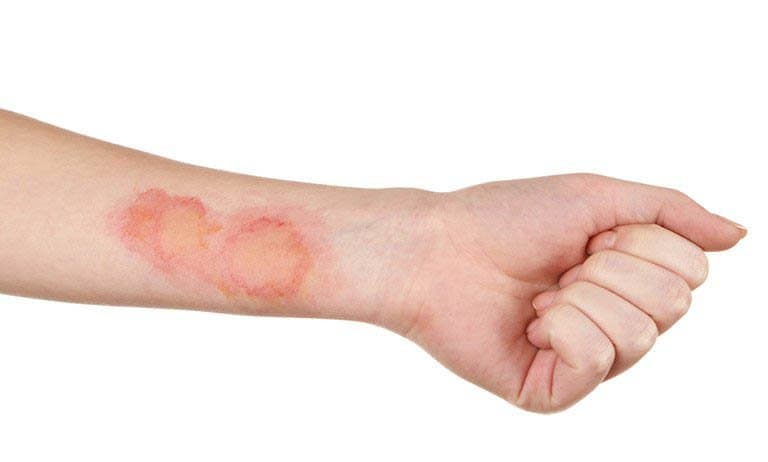 Viêm cơ nhiễm khuẩn là gì? Dấu hiệu, nguyên nhân, chẩn đoán và điều trị