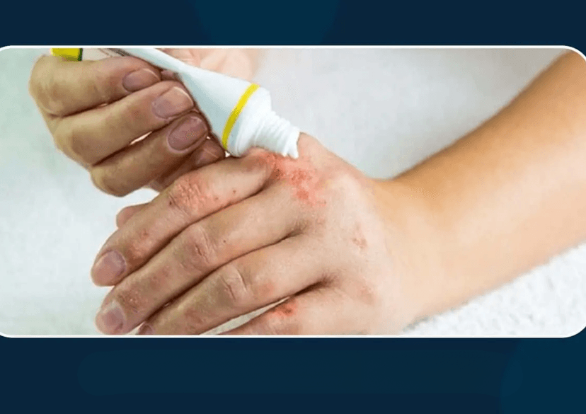 Viêm da dị ứng là gì? Nguyên nhân, triệu chứng và cách điều trị hiệu quả