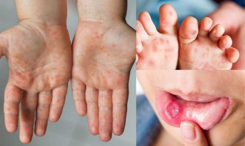 Bệnh Tay Chân Miệng Là Gì? Triệu Chứng, Nguyên Nhân Và Cách Phòng Ngừa