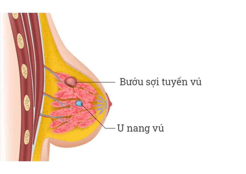 Bướu sợi tuyến vú: Nguyên nhân, triệu chứng, chẩn đoán và điều trị