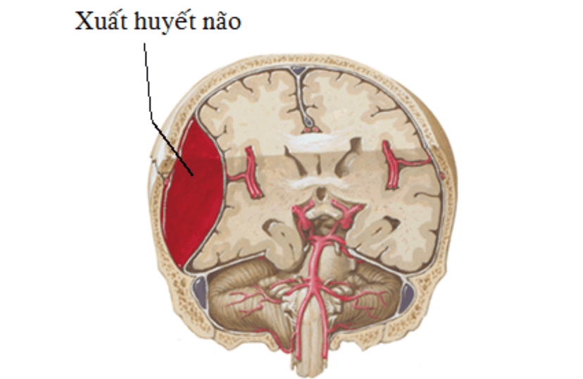 Xuất huyết não là gì? Những điều cần biết về xuất huyết não
