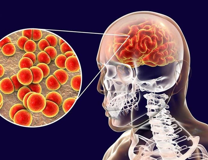 Bệnh viêm não là gì? Những điều cần biết về bệnh
