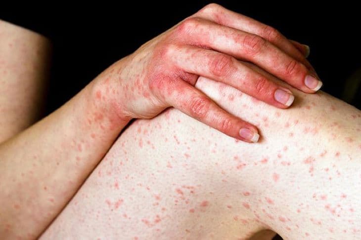 Viêm da cơ địa: Nguyên nhân, triệu chứng, cách điều trị và phòng ngừa