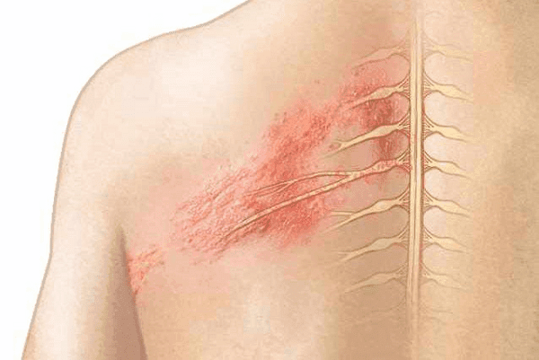 Zona Thần Kinh Là Gì? Triệu Chứng, Nguyên Nhân Và Cách Điều Trị Hiệu Quả
