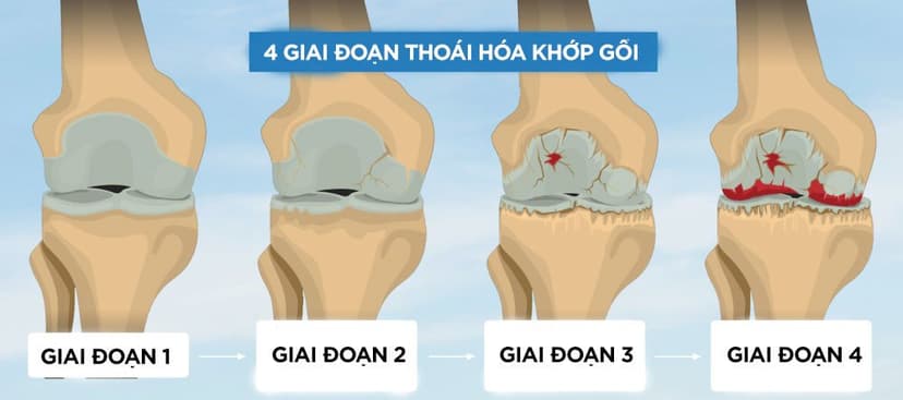 Thoái hóa khớp gối: Nguyên nhân, biểu hiện, điều trị và cách phòng bệnh