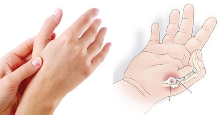 Viêm khớp ngón tay cái là gì? Những điều cần biết về viêm khớp ngón tay cái