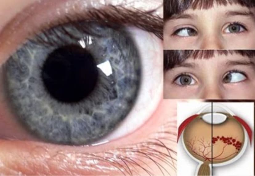 Hội chứng mắt mèo là gì? Những thông tin cần biết