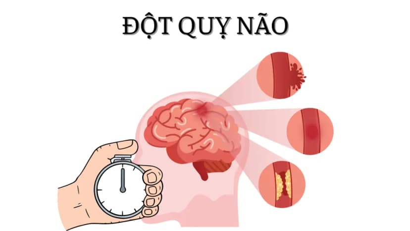 Đột quỵ não là gì? Những điều cần biết về đột quỵ não