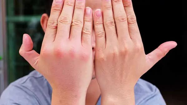 Bệnh Beriberi là gì? Nguyên nhân, triệu chứng, phương pháp phòng ngừa