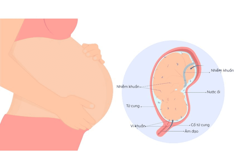 Nhiễm Trùng Ối: Nguyên Nhân, Triệu Chứng và Cách Phòng Ngừa Hiệu Quả