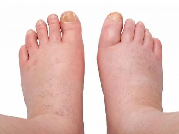 Bệnh thận do đái tháo đường là gì? Những điều bạn cần biết