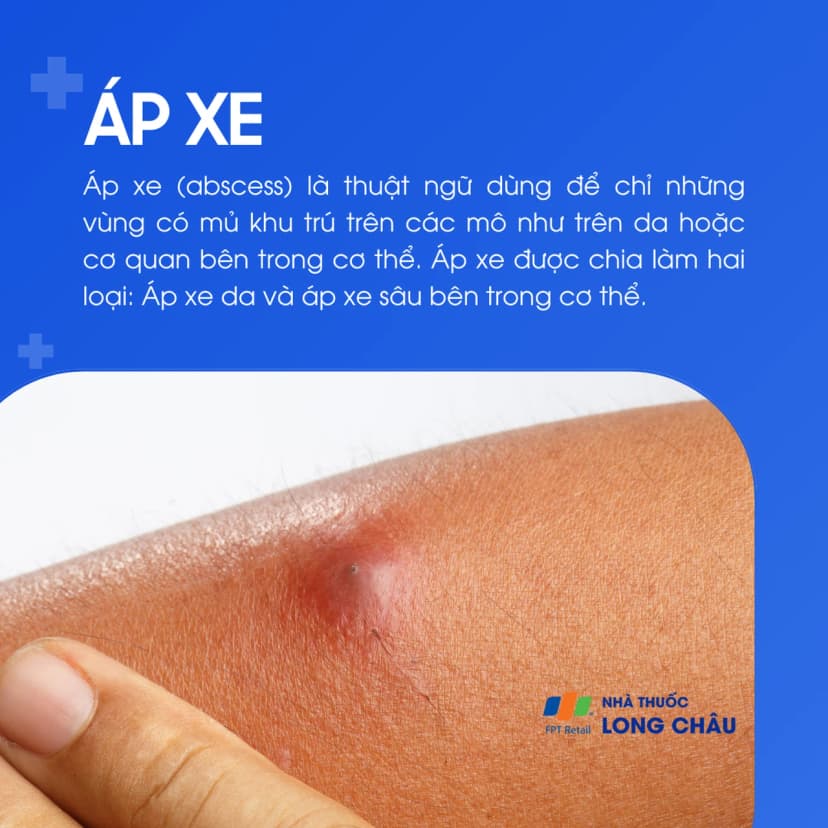 Áp xe (Abscess): Triệu chứng, nguyên nhân và cách điều trị