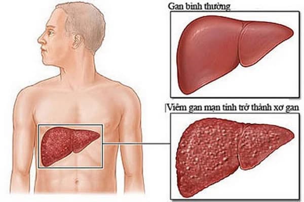 Viêm gan mạn: Triệu chứng, nguyên nhân và điều trị