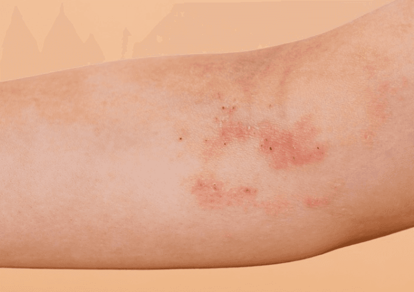 Viêm da do tiếp xúc là gì? Nguyên nhân gây bệnh và nguyên tắc phòng ngừa