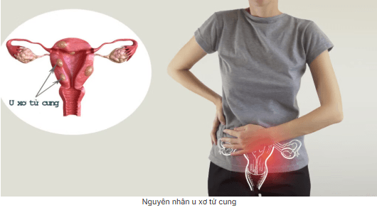 U cơ trơn tử cung là gì? Dấu hiệu, nguyên nhân, chẩn đoán và điều trị