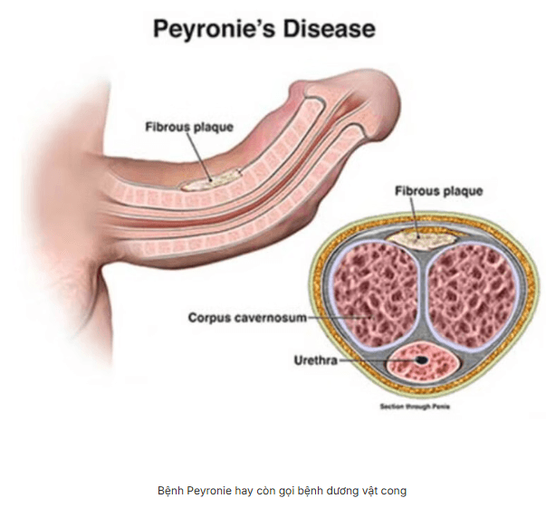Bệnh Peyronie là gì? Dấu hiệu, nguyên nhân, chẩn đoán và điều trị
