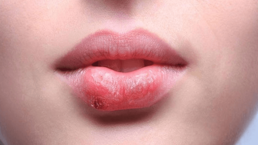 Chàm môi là gì? Nguyên nhân gây bệnh và nguyên tắc phòng ngừa