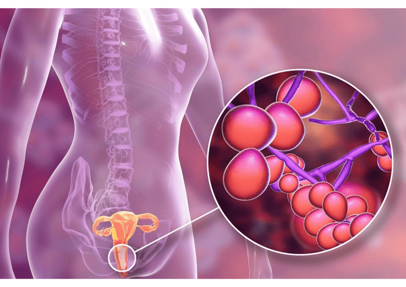 Nấm âm đạo là gì? Triệu chứng, nguyên nhân và cách điều trị hiệu quả