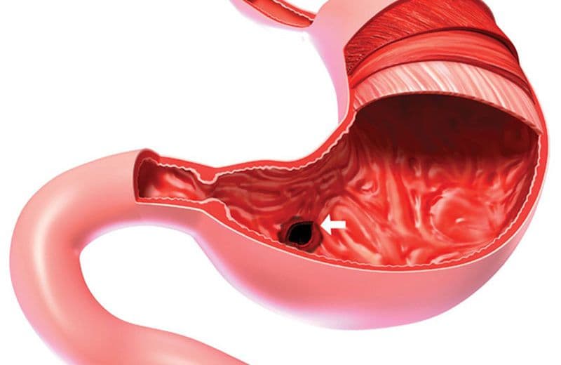 9 Cách Tự Nhiên Ngăn Ngừa Cơn Đau Dạ Dày Bạn Cần Biết