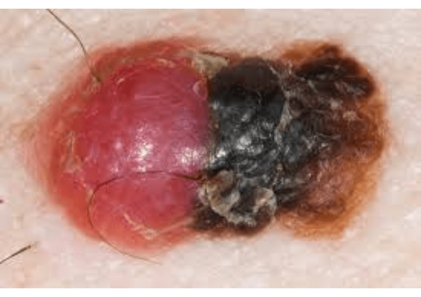 U Tế Bào Hắc Tố (Melanoma): Những điều bạn cần biết về căn bệnh này