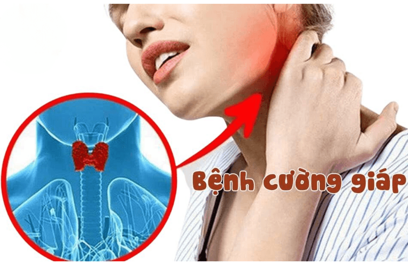 Cường Giáp Là Gì? Triệu Chứng, Nguyên Nhân Và Hướng Điều Trị Hiệu Quả
