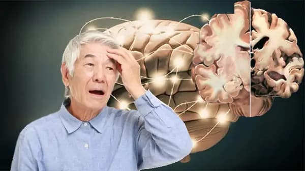 Bệnh Alzheimer là gì? Nguyên nhân, triệu chứng và cách phòng ngừa