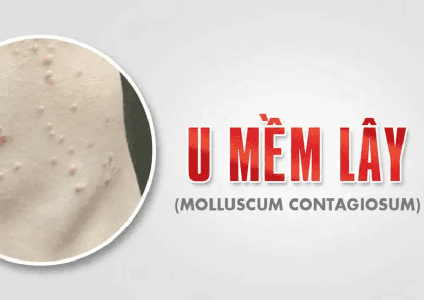 U mềm lây là gì? Triệu chứng, nguyên nhân và cách điều trị