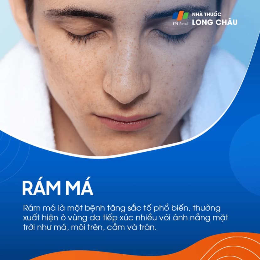Rám má là gì? Nguyên nhân gây bệnh, nguyên tắc phòng ngừa và điều trị