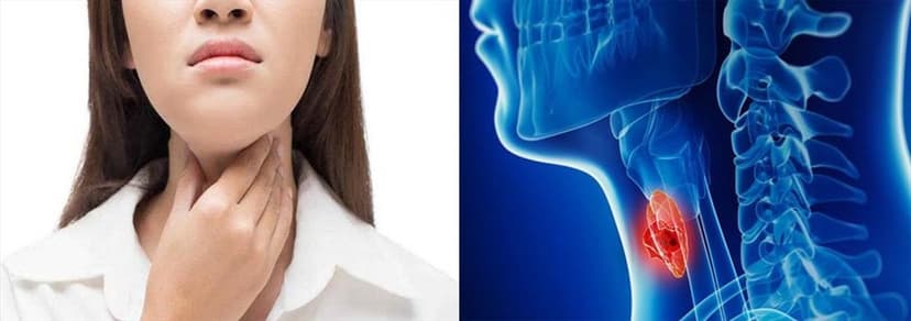Ung Thư Hạ Họng: Dấu hiệu, nguyên nhân và điều trị hiệu quả