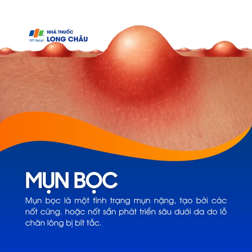 Mụn bọc là gì? Những điều bạn cần biết về mụn bọc
