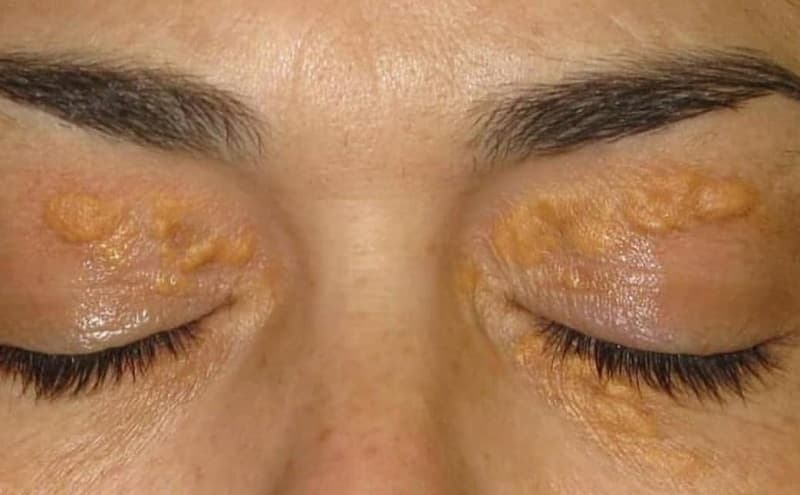 Cholesterol máu cao là gì? Dấu hiệu, nguyên nhân, chẩn đoán và điều trị