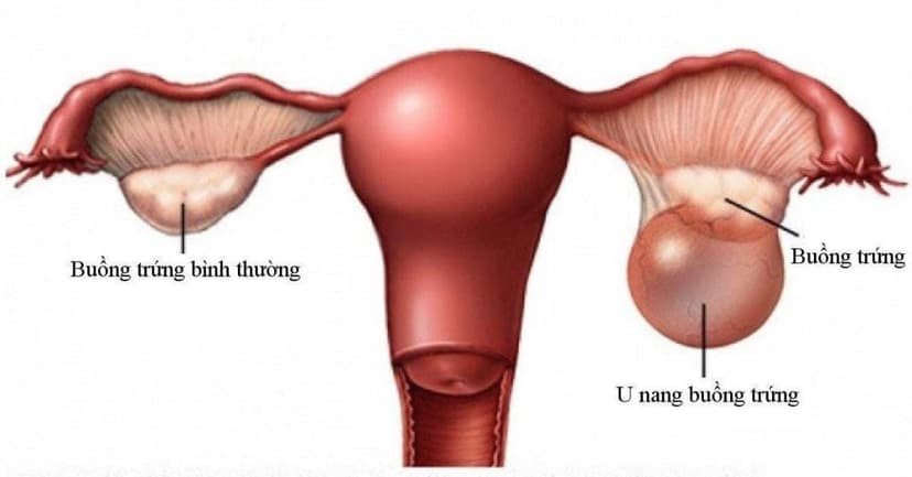 U nang buồng trứng: Nguyên nhân, triệu chứng, chẩn đoán và cách điều trị
