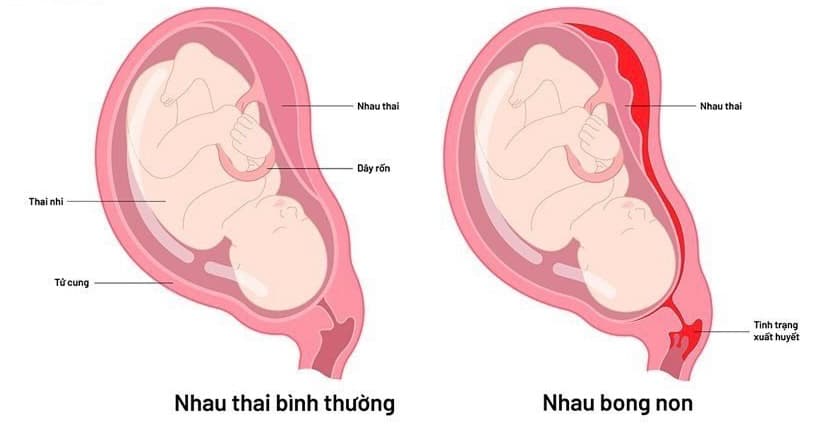 Thai lưu là gì? Những điều cần biết về thai lưu