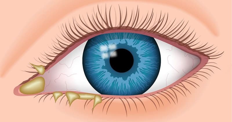 Lao ở mắt: Nguyên nhân, triệu chứng, cách điều trị và phòng bệnh