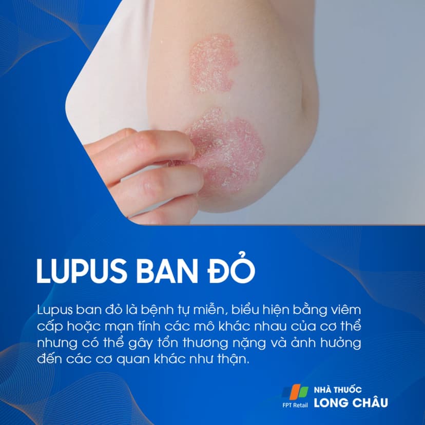 Lupus ban đỏ là gì? Nguyên nhân gây bệnh và nguyên tắc phòng ngừa