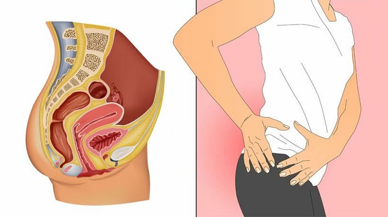 Hội chứng cơ nâng hậu môn là gì? Những điều cần biết về hội chứng cơ nâng hậu môn