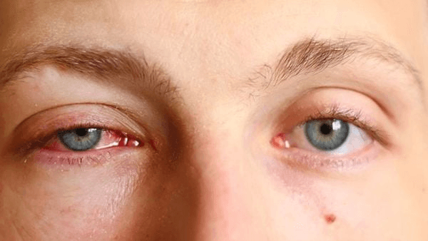 Cườm nước là gì? Nguyên nhân, triệu chứng, phòng ngừa và điều trị hiệu quả