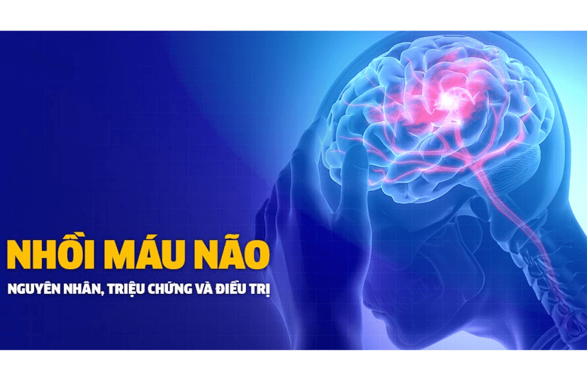 Nhồi máu não: Nguyên nhân, triệu chứng, cách điều trị và phòng ngừa