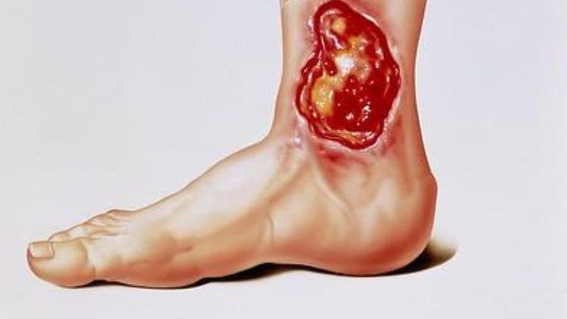 Viêm Mô Tế Bào Là Gì? Nguyên Nhân, Triệu Chứng, Điều Trị & Cách Phòng Ngừa