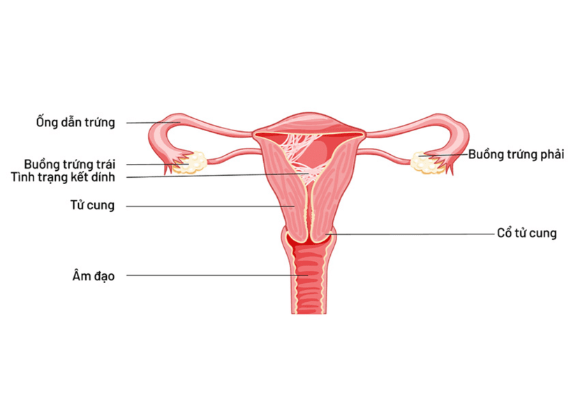 Dính buồng tử cung là gì? Nguyên nhân, triệu chứng và cách điều trị
