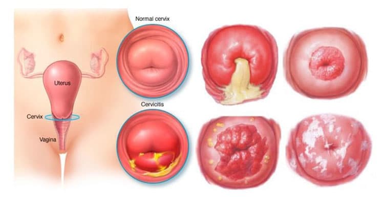 Viêm Cổ Tử Cung Là Gì? Những Điều Cần Biết Về Viêm Cổ Tử Cung Ở Phụ Nữ