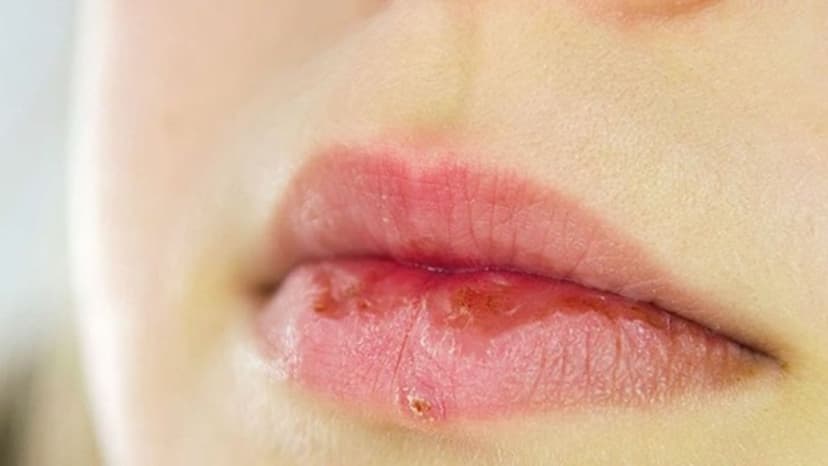 Khô môi là gì? Nguyên nhân và cách khắc phục