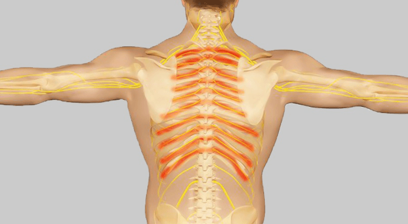 Đau thần kinh liên sườn: Nguyên nhân, triệu chứng và cách điều trị hiệu quả