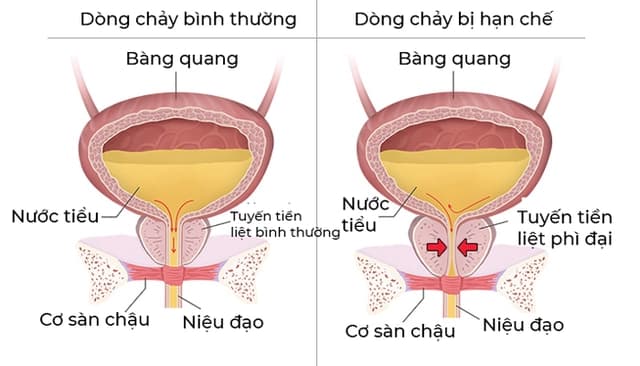 Bí tiểu là gì? Nguyên nhân, triệu chứng, biến chứng và phương pháp điều trị hiệu quả