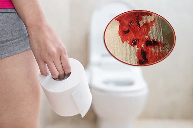 Ung Thư Ống Hậu Môn: Dấu hiệu, nguyên nhân và điều trị về bệnh này
