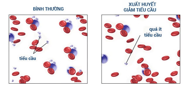 Giảm tiểu cầu miễn dịch là gì? Những điều cần biết về Giảm tiểu cầu miễn dịch