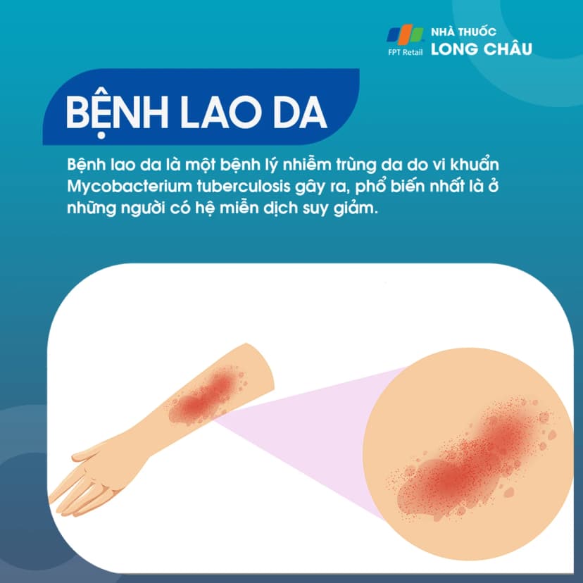 Lao da: Nguyên nhân, triệu chứng và điều trị