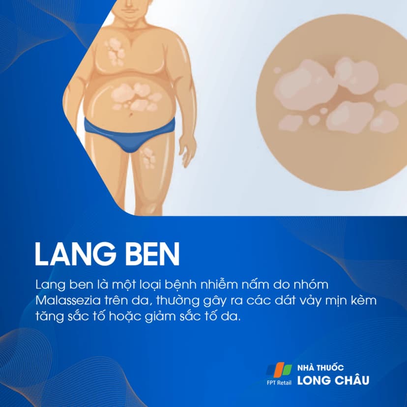 Lang ben: Triệu chứng, nguyên nhân và điều trị