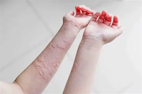 Mề Đay Là Gì? Nguyên Nhân, Triệu Chứng Và Cách Điều Trị Hiệu Quả